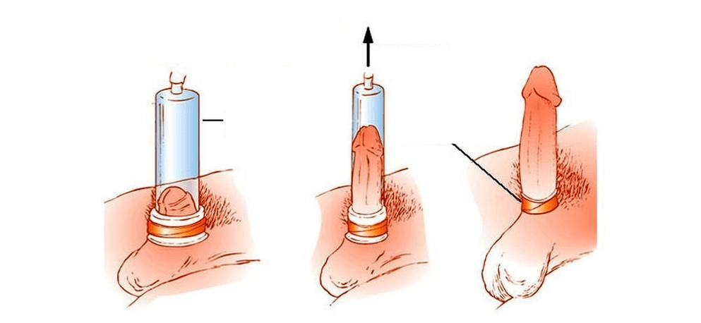 cum funcționează o pompă de vid pentru mărirea penisului