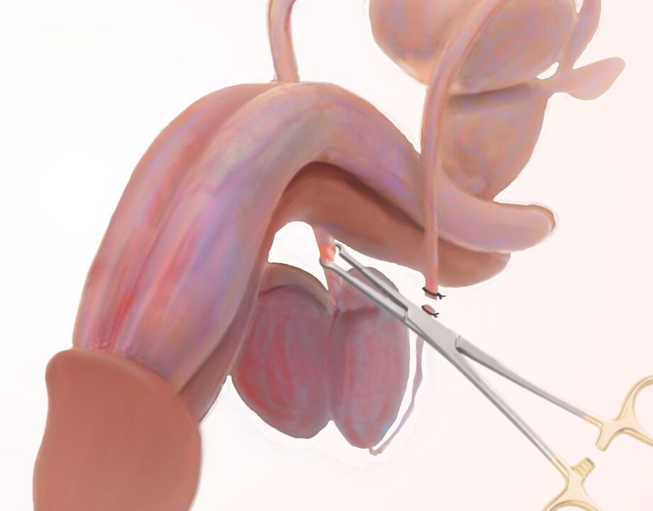 ligamentotomie pentru marirea penisului
